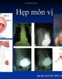 Đại cương: Hẹp môn vị