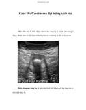 Case 10: Carcinoma đại tràng xích ma