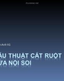 Bài giảng Phẫu thuật cắt ruột thừa nội soi - TS. Phạm Anh Vũ