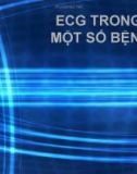 Bài giảng ECG trong một số bệnh