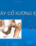 Bài giảng Gãy cổ xương đùi - Dr. Thanh