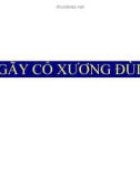 Bài giảng Gãy cổ xương đùi (16 trang)