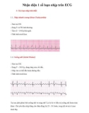 Nhận diện 1 số loạn nhịp trên ECG