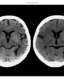 CT Scan trong tai biến mạch máu não part 9