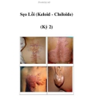 Sẹo Lồi (Keloid - Chéloïde) (Kỳ 2)