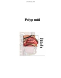 Polyp mũi