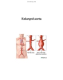 Enlarged aorta