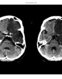 CT Scan trong tai biến mạch máu não part 10