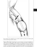 Access for Dialysis: Surgical and Radiologic Procedures - part 3