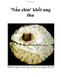 'Nấu chín' khối ung thư