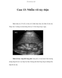 Case 13: Nhiễm vôi tủy thận