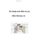 Kỹ thuật mới điều trị các chấn thương vai