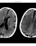 CT Scan trong tai biến mạch máu não part 6