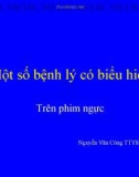 Bài giảng Một số bệnh lý có biểu hiện trên phim ngực - Nguyễn Văn Công