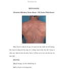 BỆNH DARIER (Keratosis follicularis, Darier disease – DD, Darier-White disease)