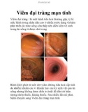 Viêm đại tràng mạn tính