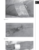 Access for Dialysis: Surgical and Radiologic Procedures - part 9