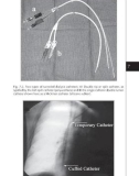 Access for Dialysis: Surgical and Radiologic Procedures - part 5