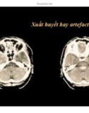 CT Scan trong tai biến mạch máu não part 2