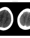 CT Scan trong tai biến mạch máu não part 7