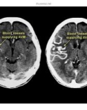 CT Scan trong tai biến mạch máu não part 8