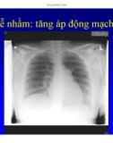 Bài giảng điều trị HIV : Các hội chứng hô hấp trong nhiễm HIV part 5