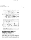 Basic Electrocardiography Normal and abnormal ECG patterns - Part 3