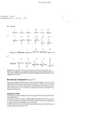 Basic Electrocardiography Normal and abnormal ECG patterns - Part 4