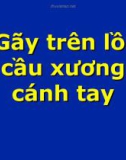 Giải phẫu bệnh: Gãy trên lồi cầu xương cánh tay