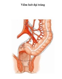 Viêm loét đại tràng