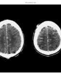 CT Scan trong tai biến mạch máu não part 5