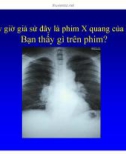 Bài giảng điều trị H3IV : Các hội chứng hô hấp trong nhiễm HIV part