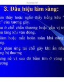 Kỹ Thuật Cố Định Tạm Thời Xương Gãy (Phần 2)