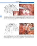 Endoscopic Extraperitoneal Radical Prostatectomy - part 6