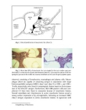 Otosclerosis and Stapes Surgery - part 2