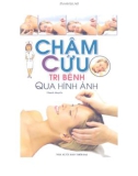 Hướng dẫn Châm cứu trị bệnh qua hình ảnh: Phần 1