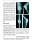 Total Knee Arthroplasty - part 3