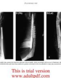 Bone Regeneration and Repair - part 9