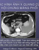 Chuẩn đoán X quang trong hội chứng màng phổi