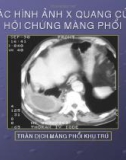 Chuẩn đoán X quang hội chứng màng phổi