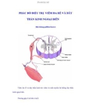 PHÁC ĐỒ ĐIỀU TRỊ VIÊM ĐA RỄ VÀ DÂY THẦN KINH NGOẠI BIÊN