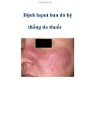 Bệnh luput ban đỏ hệ thống do thuốc