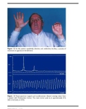 PARKINSON'S DISEASE AND RELATED DISORDERS - PART 5