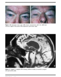 PARKINSON'S DISEASE AND RELATED DISORDERS - PART 6