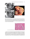 Acquired Cystic Disease of the Kidney and Renal Cell Carcinoma - part 9