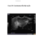 Case 33: Carcinoma tiền liệt tuyến