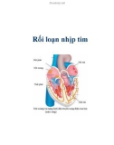 Rối loạn nhịp tim