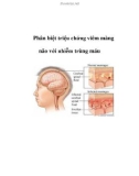 Phân biệt triệu chứng viêm màng não với nhiễm trùng máu