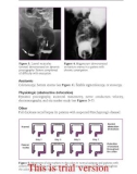 Anal and rectal diseases explained - part 4