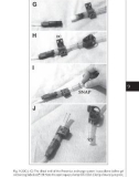 Access for Dialysis: Surgical and Radiologic Procedures - part 8